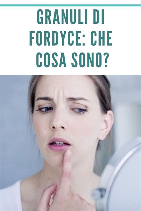 i granuli di fordyce|Granuli di Fordyce: cosa sono e come si curano